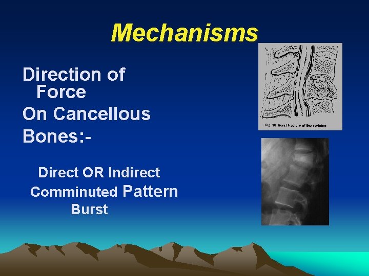 Mechanisms Direction of Force On Cancellous Bones: Direct OR Indirect Comminuted Pattern Burst 