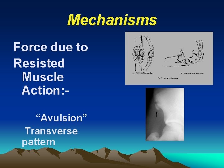 Mechanisms Force due to Resisted Muscle Action: “Avulsion” Transverse pattern 