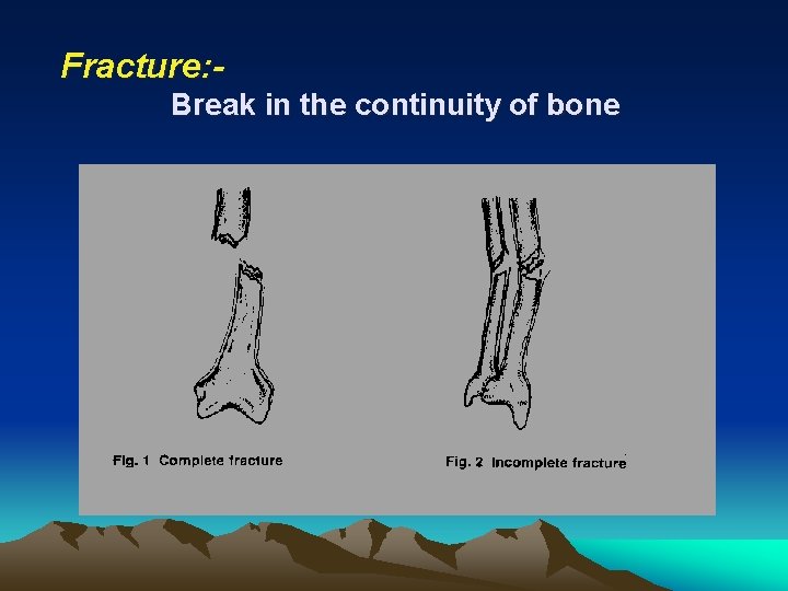 Fracture: Break in the continuity of bone 