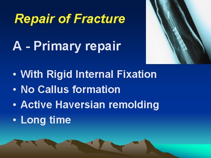 Repair of Fracture A - Primary repair • • With Rigid Internal Fixation No