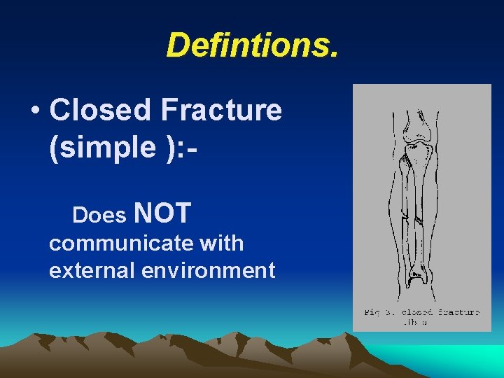 Defintions. • Closed Fracture (simple ): Does NOT communicate with external environment 