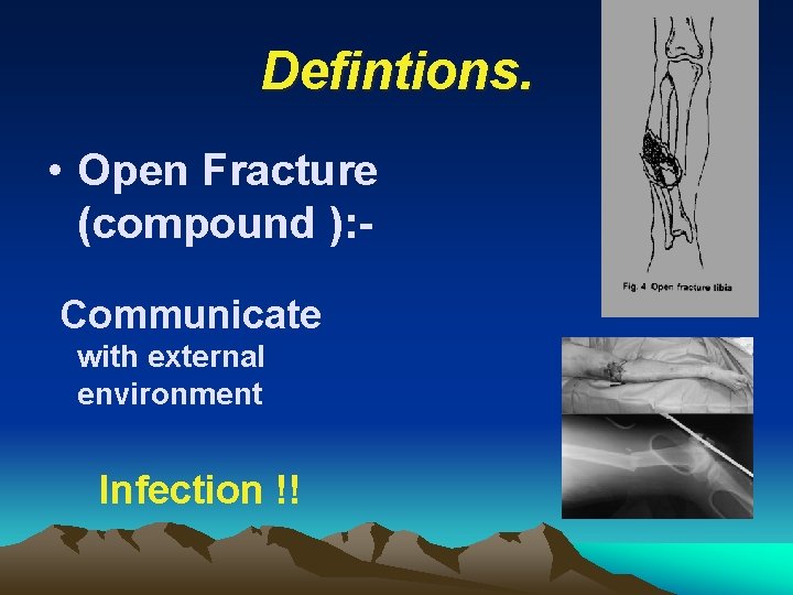 Defintions. • Open Fracture (compound ): Communicate with external environment Infection !! 