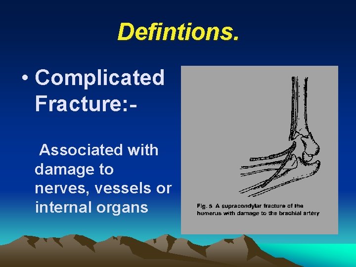 Defintions. • Complicated Fracture: Associated with damage to nerves, vessels or internal organs 