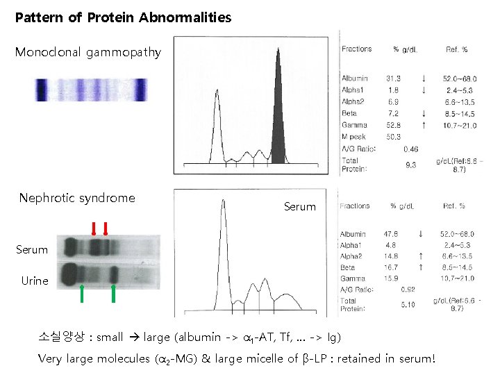 Pattern of Protein Abnormalities Monoclonal gammopathy Nephrotic syndrome Serum Urine 소실양상 : small large