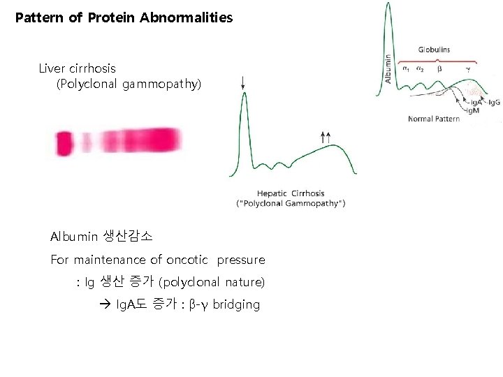 Pattern of Protein Abnormalities Liver cirrhosis (Polyclonal gammopathy) Albumin 생산감소 For maintenance of oncotic