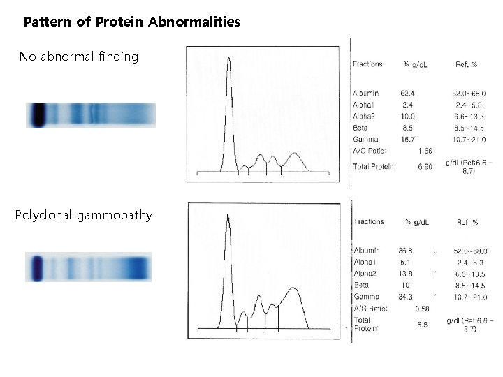 Pattern of Protein Abnormalities No abnormal finding Polyclonal gammopathy 