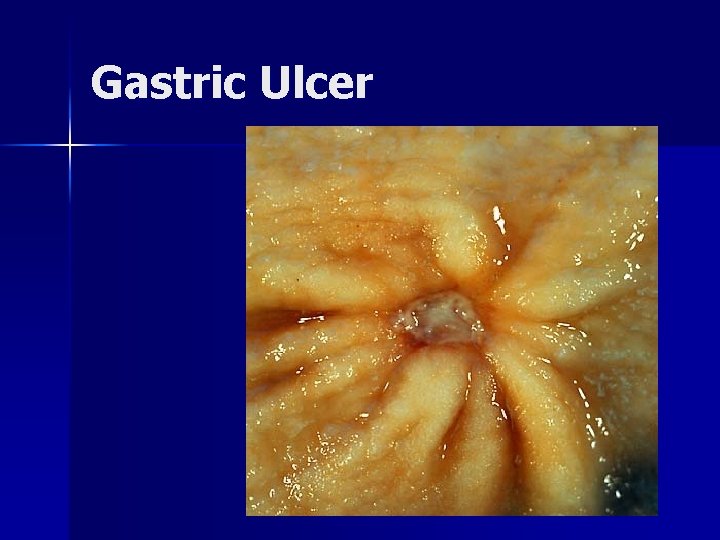 Gastric Ulcer 