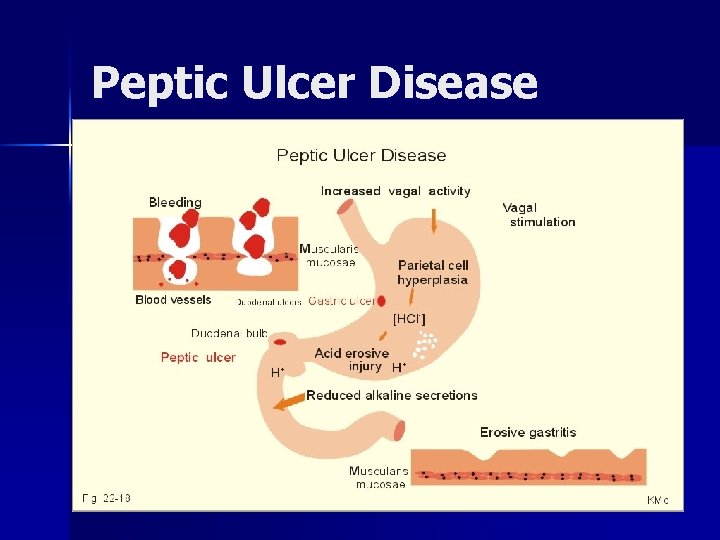 Peptic Ulcer Disease 