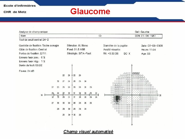 Glaucome Champ visuel automatisé 