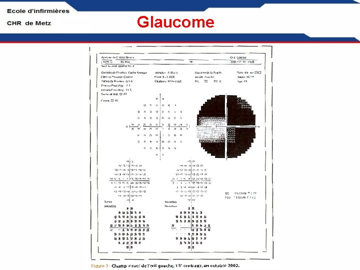 Glaucome 