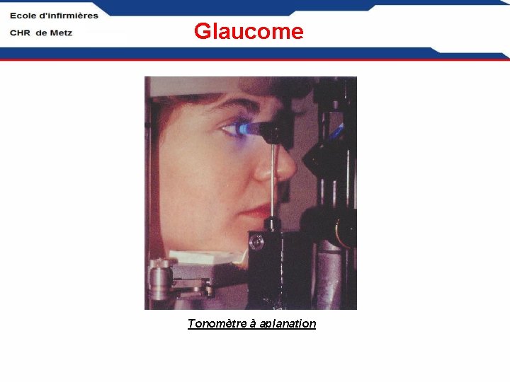 Glaucome Tonomètre à aplanation 