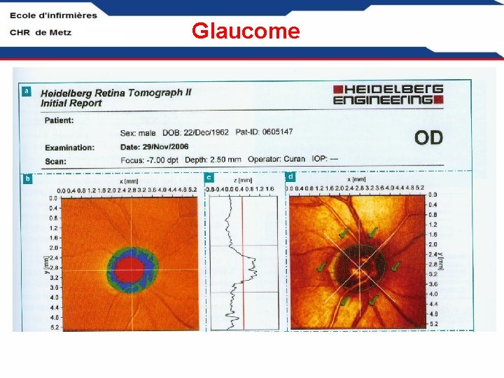 Glaucome 