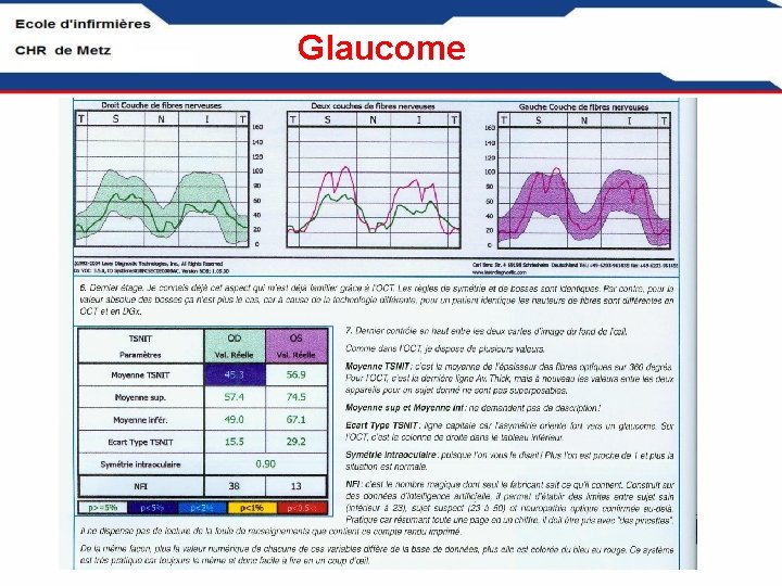 Glaucome 