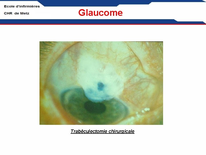 Glaucome Trabéculectomie chirurgicale 