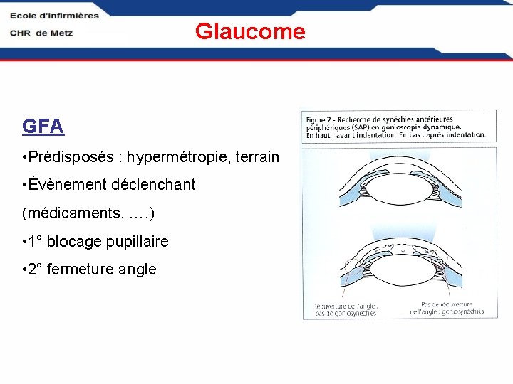 Glaucome GFA • Prédisposés : hypermétropie, terrain • Évènement déclenchant (médicaments, …. ) •