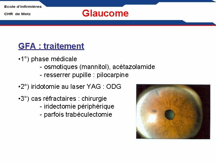 Glaucome GFA : traitement • 1°) phase médicale - osmotiques (mannitol), acétazolamide - resserrer