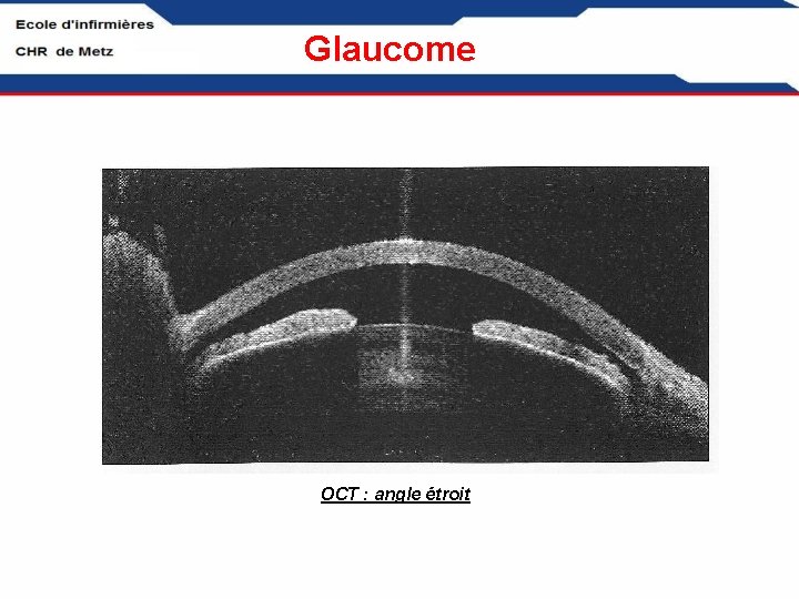 Glaucome OCT : angle étroit 