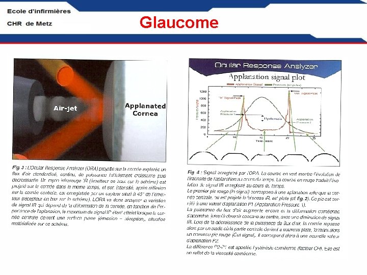 Glaucome 