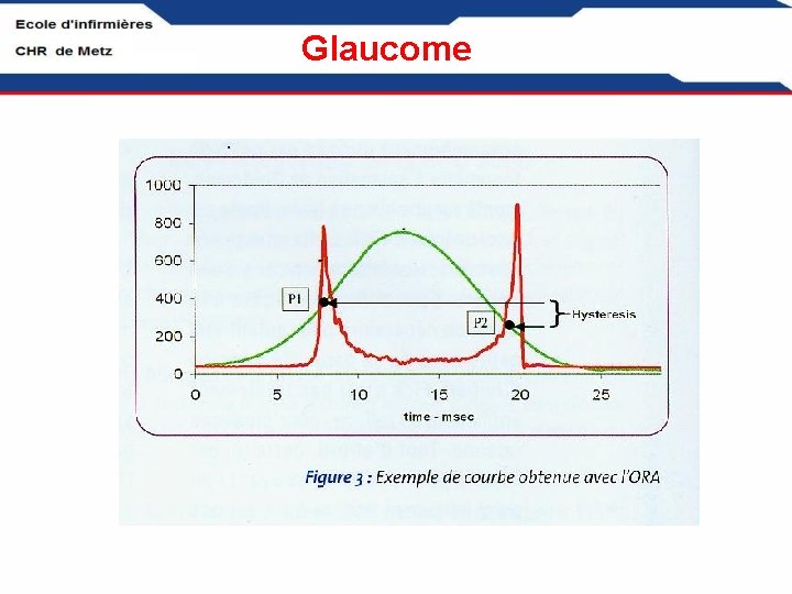 Glaucome 