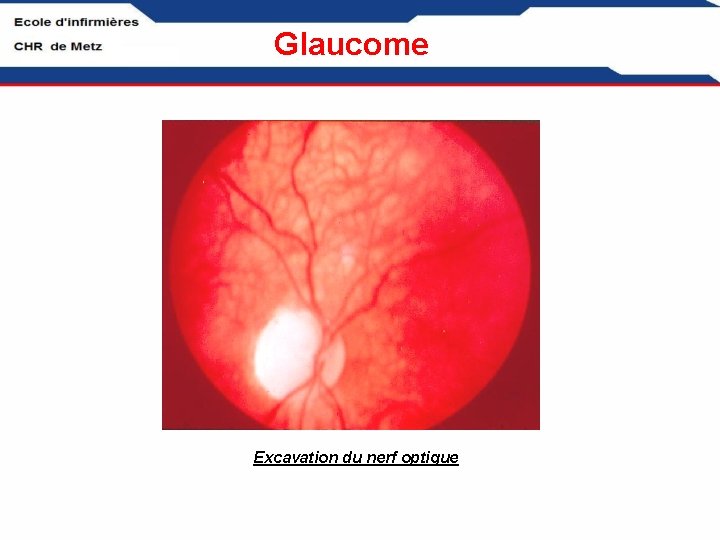 Glaucome Excavation du nerf optique 
