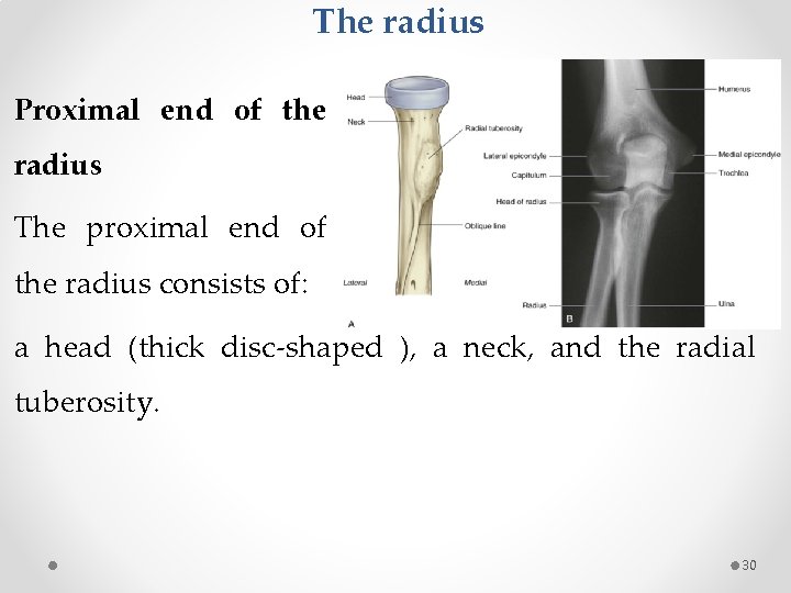 The radius Proximal end of the radius The proximal end of the radius consists