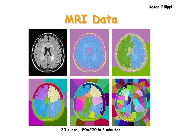 Data: Filippi MRI Data 30 slices, 180 x 220 in 3 minutes 