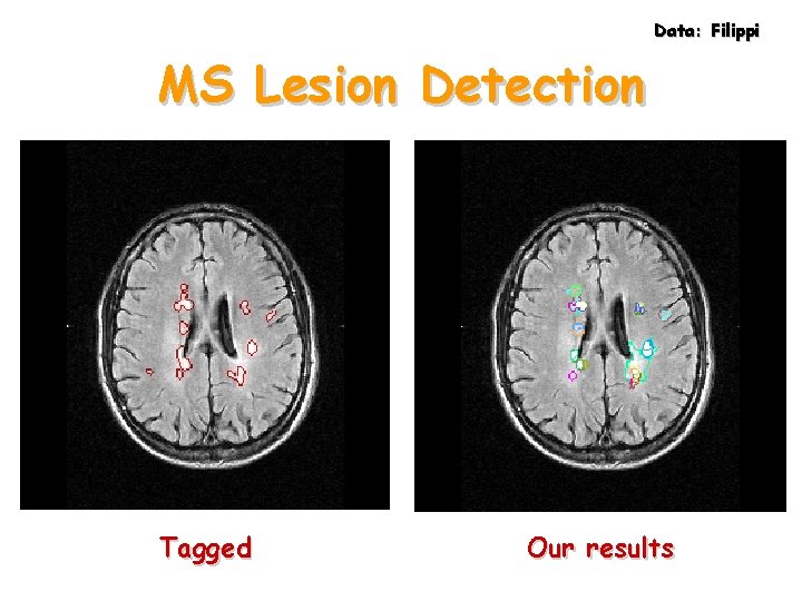 Data: Filippi MS Lesion Detection Tagged Our results 