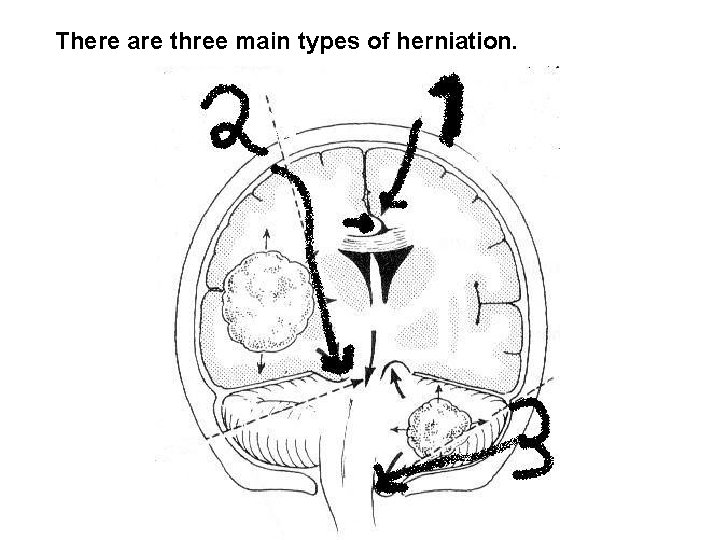 There are three main types of herniation. 