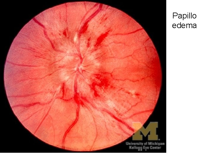 Papillo edema 