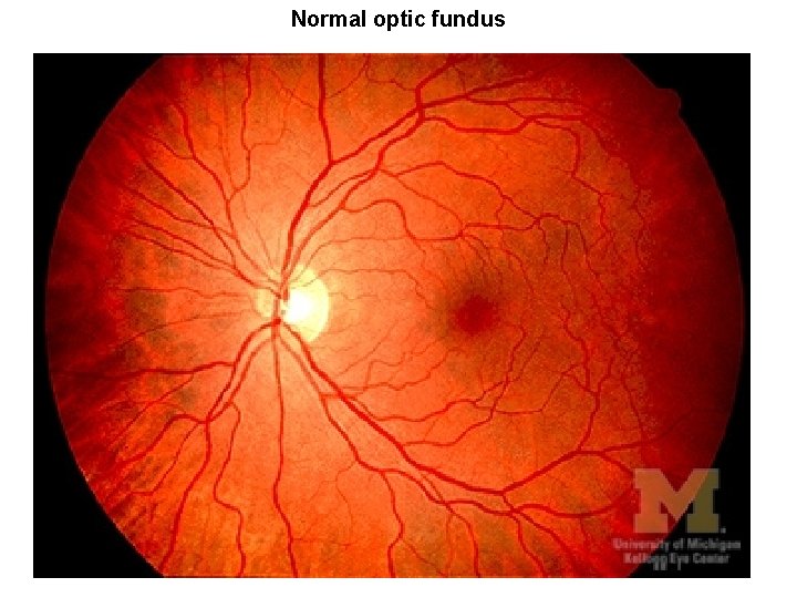 Normal optic fundus 