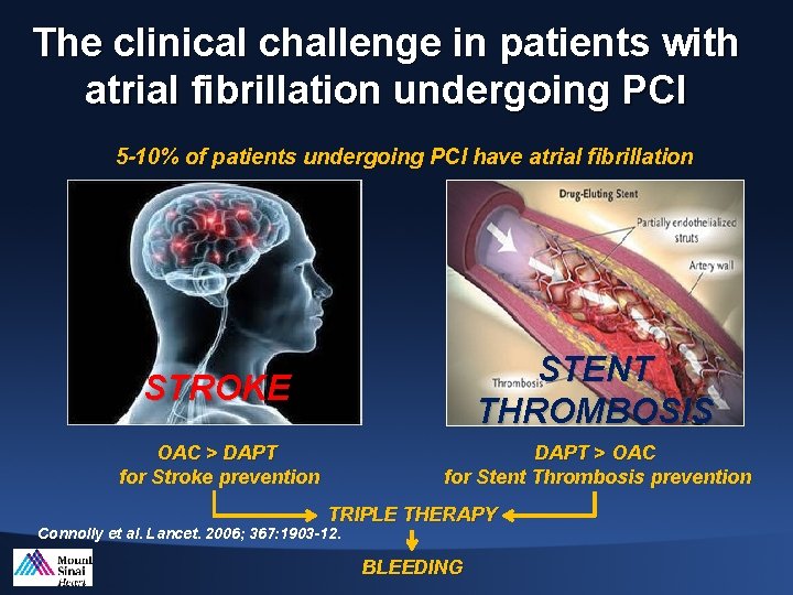 The clinical challenge in patients with atrial fibrillation undergoing PCI 5 -10% of patients