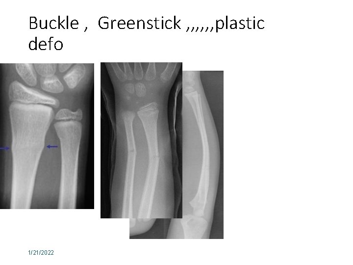 Buckle , Greenstick , , , plastic defo 1/21/2022 42 
