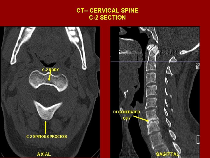CT-- CERVICAL SPINE C-2 SECTION C-2 BODY DEGENERATED C 6 -7 C-2 SPINOUS PROCESS