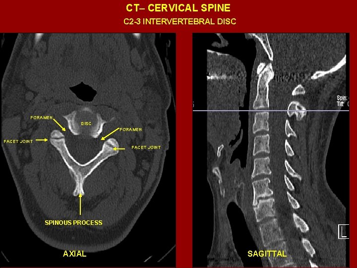 CT– CERVICAL SPINE C 2 -3 INTERVERTEBRAL DISC FORAMEN FACET JOINT SPINOUS PROCESS AXIAL