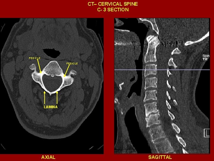 CT– CERVICAL SPINE C- 3 SECTION PEDICLE LAMINA AXIAL SAGITTAL 