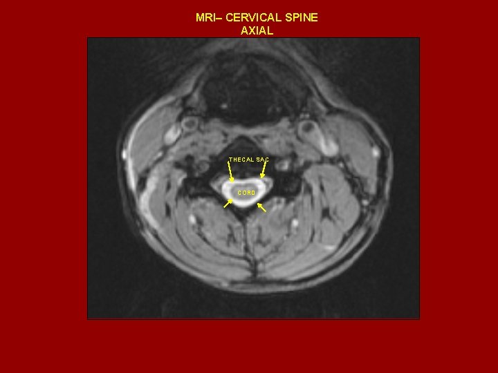 MRI– CERVICAL SPINE AXIAL THECAL SAC CORD 