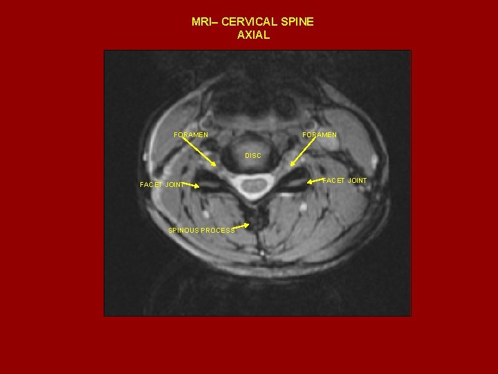 MRI– CERVICAL SPINE AXIAL FORAMEN DISC FACET JOINT SPINOUS PROCESS FACET JOINT 