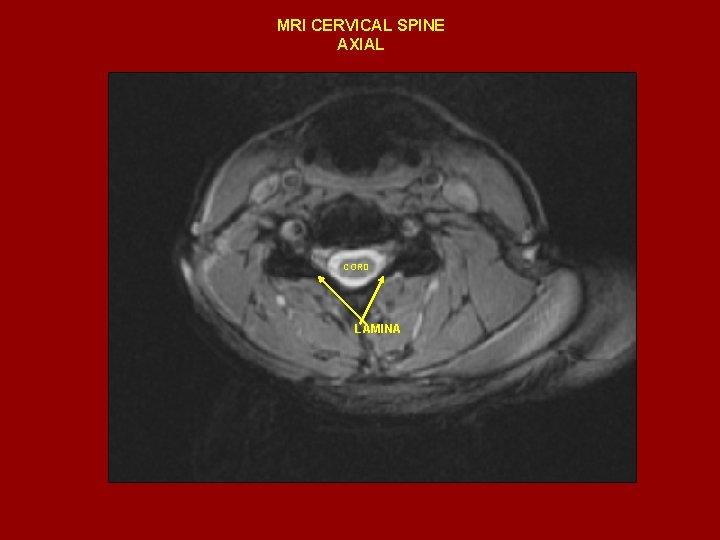 MRI CERVICAL SPINE AXIAL CORD LAMINA 