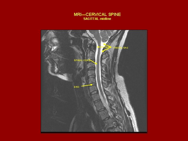 MRI—CERVICAL SPINE SAGITTAL-midline THECAL SAC SPINAL CORD DISC 