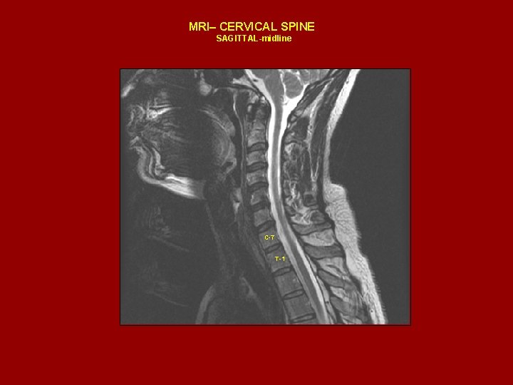 MRI– CERVICAL SPINE SAGITTAL-midline C-7 T-1 