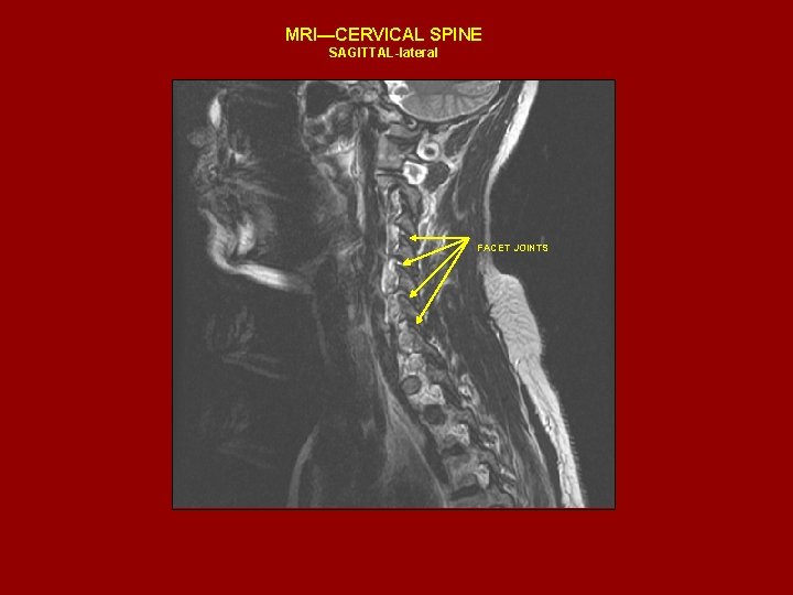 MRI—CERVICAL SPINE SAGITTAL-lateral FACET JOINTS 