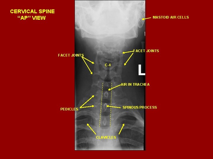 CERVICAL SPINE “AP” VIEW MASTOID AIR CELLS FACET JOINTS C-4 AIR IN TRACHEA SPINOUS