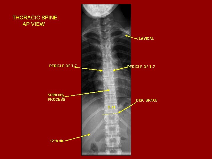 THORACIC SPINE AP VIEW CLAVICAL PEDICLE OF T-7 SPINOUS PROCESS DISC SPACE T-11 12