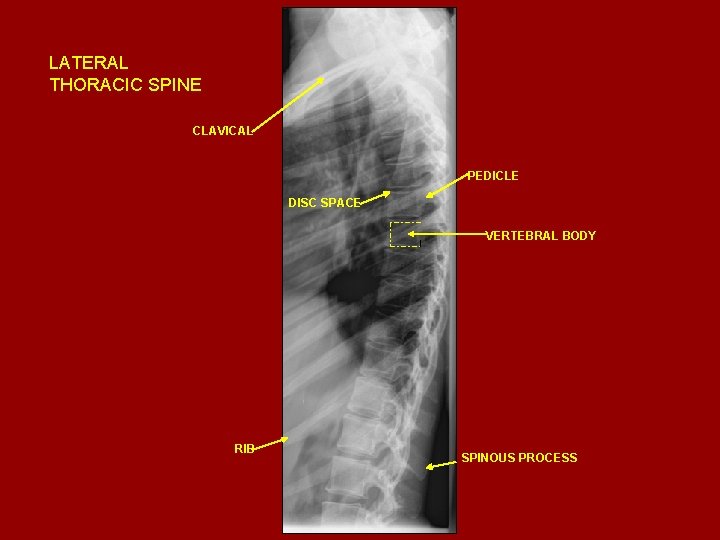 LATERAL THORACIC SPINE CLAVICAL PEDICLE DISC SPACE VERTEBRAL BODY RIB SPINOUS PROCESS 