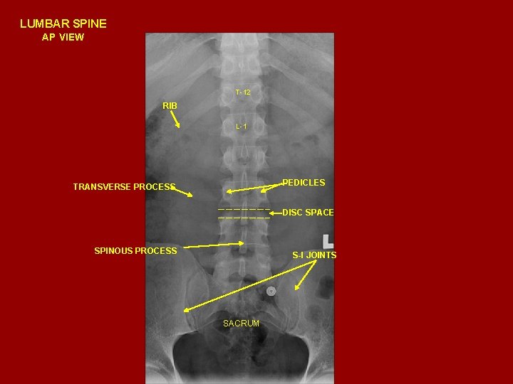 LUMBAR SPINE AP VIEW T-12 RIB L-1 PEDICLES TRANSVERSE PROCESS DISC SPACE SPINOUS PROCESS