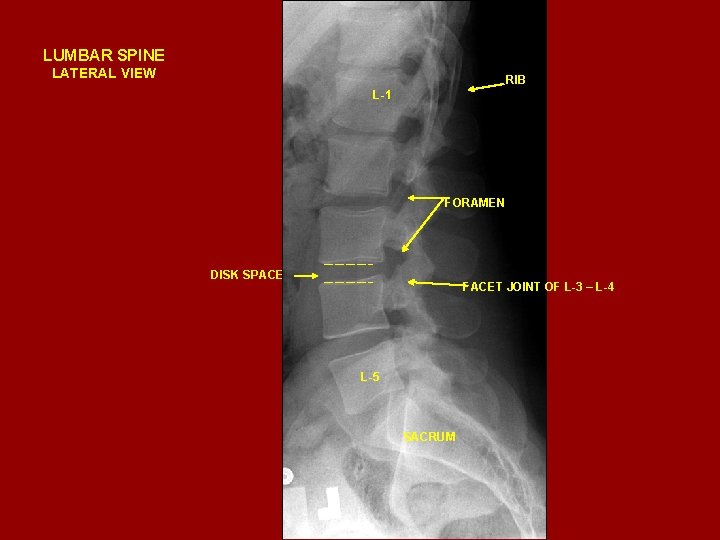 LUMBAR SPINE LATERAL VIEW RIB L-1 FORAMEN DISK SPACE FACET JOINT OF L-3 –