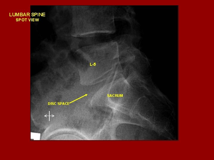 LUMBAR SPINE SPOT VIEW L-5 SACRUM DISC SPACE 