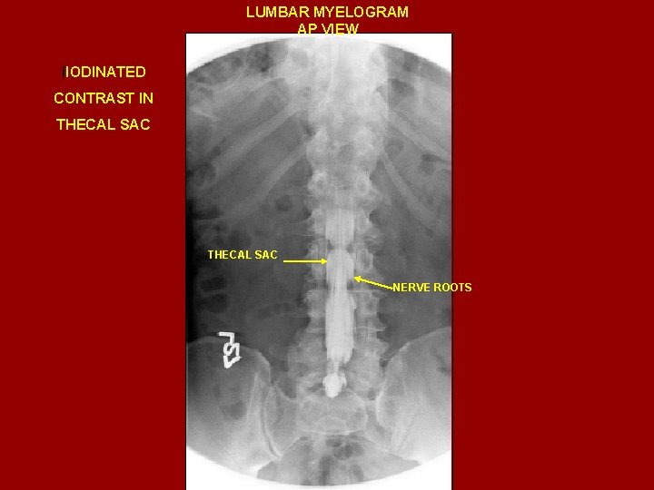 LUMBAR MYELOGRAM AP VIEW IIODINATED CONTRAST IN THECAL SAC NERVE ROOTS 