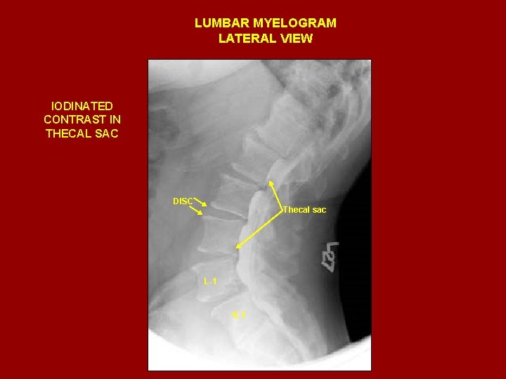 LUMBAR MYELOGRAM LATERAL VIEW IODINATED CONTRAST IN THECAL SAC DISC Thecal sac L-1 S-1