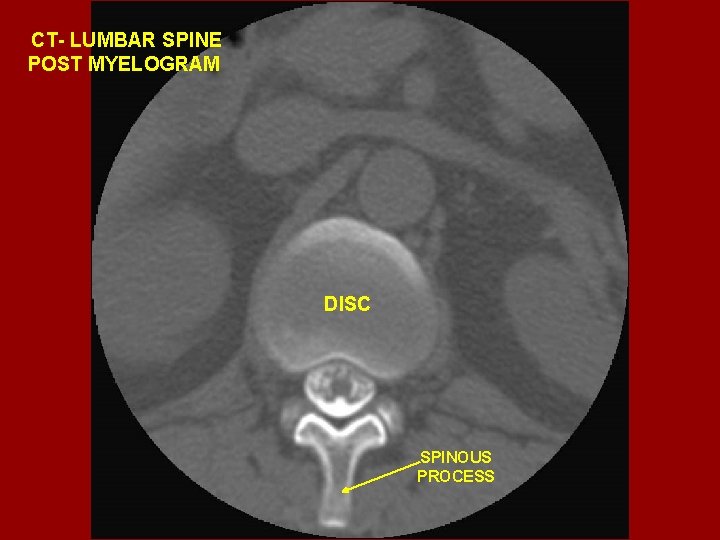 CT- LUMBAR SPINE POST MYELOGRAM DISC SPINOUS PROCESS 